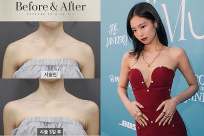 Viral di Korea, Wanita Ramai Filler Bahu Demi Punya Bahu 90 Derajat ala Jennie BLACKPINK