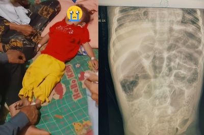 Kisah Pilu Raya, Balita di Sukabumi yang Meninggal Dunia dengan Tubuh Penuh Cacing