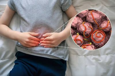 Ini Waktu yang Pas Konsumsi Obat Cacing Menurut Dokter, Harus Ada Gejalanya!