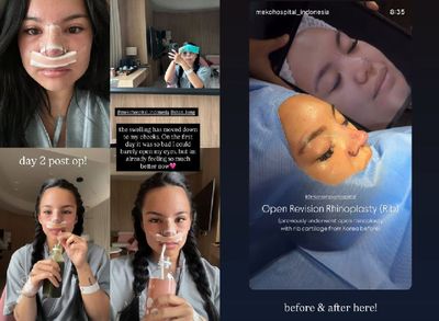 Penampilan Terbaru Shafa Harris Usai Oplas di Thailand, Hidung Lebih Lancip dan Tegas