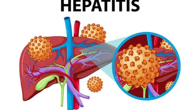 Peringatan Hari Hepatitis Sedunia: Pentingnya Kesadaran dan Pencegahan