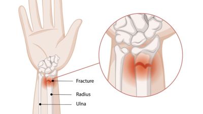 Osteopenia: Ketahui Penyebab dan Pentingnya Pendeteksian Dini
