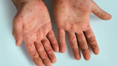 WHO Tetapkan Mpox Sebagai Darurat Kesehatan Global, Lonjakan Kasus Terjadi di Indonesia