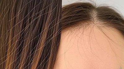 Penyebab Rambut Rontok pada Usia Muda