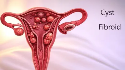 Kista dan Miom: Penyakit yang Tak Hanya Menghantui Wanita Usia Tua