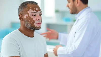 Vitiligo: Memahami Kelainan Kulit dan Cara Penanganannya