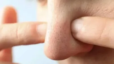 Tips Ampuh Cegah Komedo di Area Hidung