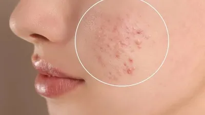 Mengatasi Jerawat Saat PMS: Tips Perawatan Kulit yang Efektif