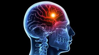 Mitos Medis: Stroke Bukan Sekadar Penyakit Orang Tua, Ini Fakta Sebenarnya
