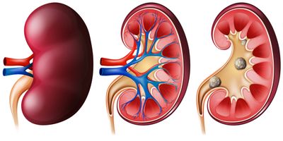 Tanda Gagal Ginjal dan Stroke yang Terlihat pada Kaki: Wajib Diketahui