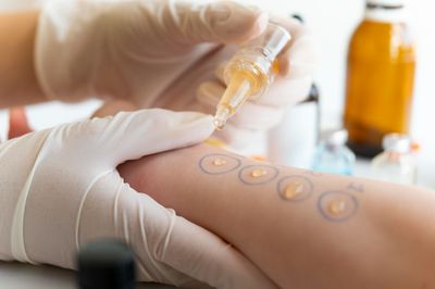 Masuk Musim Penghujan Kasus Alergi Anak Meningkat, Dokter UGM Beri Solusi Cara Efektif Mencegahnya