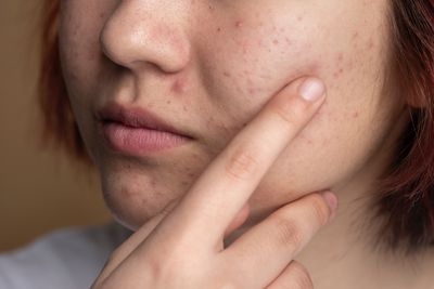 Sudah Coba Semua Skincare Tapi Jerawat Bandel? Kandungan Sulfur Nendang untuk Masalah Kulitmu!