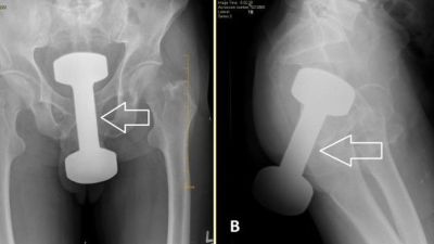 Kasus Unik di Pennsylvania: Proses Pengeluaran Dumbell dari Rektum Pasien Berusia 50 Tahun