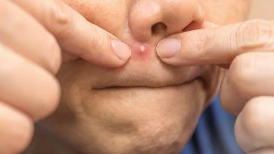 Perawatan Kulit Sehat: Tips untuk Mencegah Jerawat