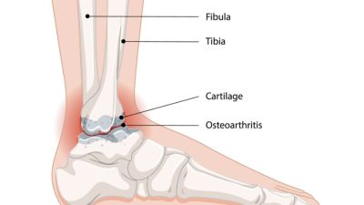 Memahami Osteoarthritis: Penyakit Umum pada Lansia di Indonesia