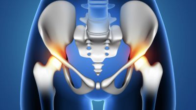 Memahami Hernia Nukleus Pulposus: Gejala, Penyebab, dan Pengobatan