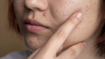 Pendekatan Alami untuk Mengatasi Jerawat: Bahan-bahan Efektif dan Cara Penggunaannya