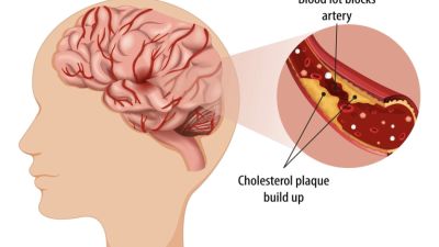 Memahami Jenis-Jenis Stroke dan Penanganannya di Indonesia