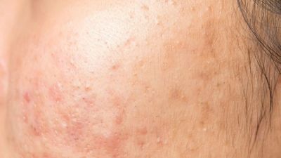 Mengetahui Skin Purging: Proses dan Cara Menghadapinya