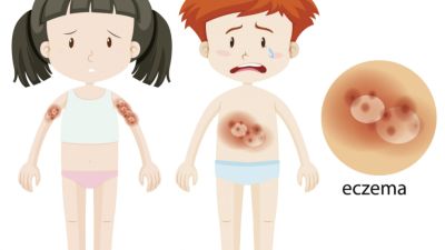 Mengenal Cacar Air: Gejala, Penyebab, dan Perawatan
