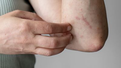 Campak: Ancaman Serius dan Pentingnya Imunisasi
