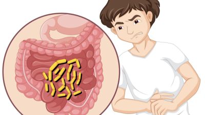 Pentingnya Kesadaran Akan Kanker Usus Besar di Indonesia