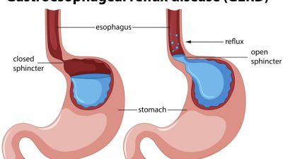 Pentingnya Memahami dan Mengatasi Gastroesophageal Reflux Disease (GERD)