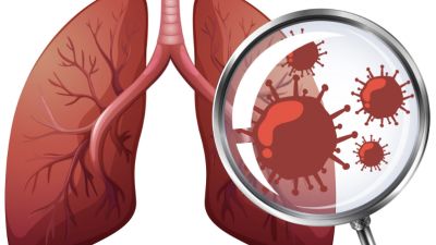Mengenal Radang Selaput Paru: Gejala dan Penanganan yang Penting Diketahui