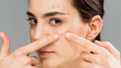 Tips Mengatasi Bekas Jerawat yang Efektif dan Aman