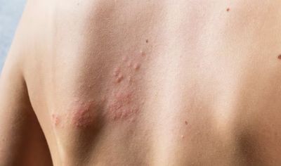 Jangan Anggap Remeh! Ini 6 Fakta Penting Herpes Genital yang Jarang Diketahui