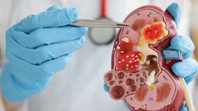 Meningkatnya Kasus Gagal Ginjal: Tinjauan Global dan Solusi yang Dibutuhkan