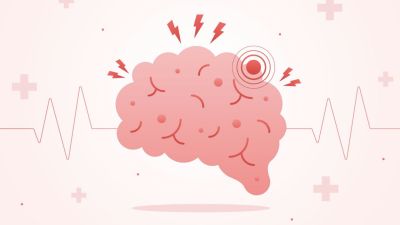 Pentingnya Kesadaran Terhadap Stroke Ringan: Tanda Peringatan Kesehatan Otak