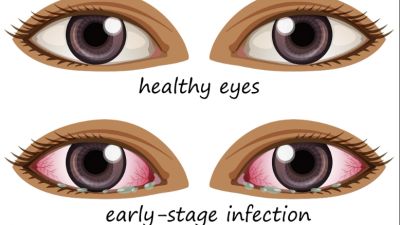 Konjungtivitis: Kenali Penyebab, Gejala, dan Pengobatannya