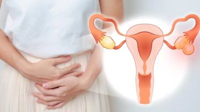 Peningkatan Kasus Kista dan Miom di Kalangan Wanita Indonesia: Penyebab dan Tinjauan Kesehatan