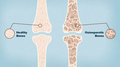 Mengenal Osteoporosis: Penyakit Tulang yang Perlu Diwaspadai