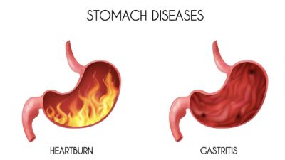 Cara Alami Meredakan Gejala Asam Lambung