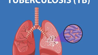 Waspadai Tuberkulosis: Gejala, Penyebaran, dan Cara Pengobatan Terkini