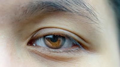 Mengenal Ptosis: Kelopak Mata Turun yang Menjadi Topik Hangat