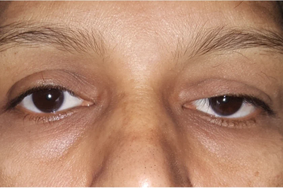 Ptosis Bukan Sekadar Mata Mengantuk, Ini Penyebab dan Dampaknya Bagi Kesehatan