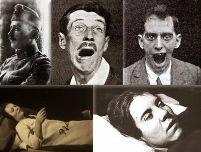 Misteri Encephalitis Lethargica, Penyakit Langka yang Muncul Bersamaan dengan Spanish Flu