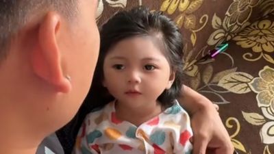 Balita Perempuan Berparas Cantik seperti Boneka Ini Alami Craniosynostosis