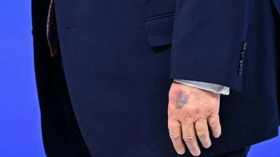 Mengungkap Lebam di Tangan Trump: Antara Aspirin dan Benturan Fisik