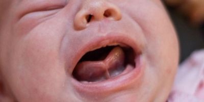 Tongue Tie pada Bayi: Ciri-Ciri, Cara Mengecek, Dampak Menyusui, hingga Biaya Operasi
