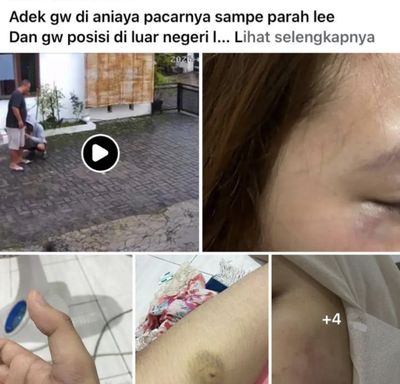UNISA Jogja Angkat Bicara Buntut Dugaan Kekerasan Mahasiswanya Terhadap Pacarnya, Keduanya Satu Almateter