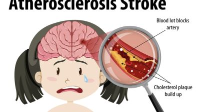 Memahami Stroke: Penyebab, Gejala, dan Tindakan Pertama yang Diperlukan