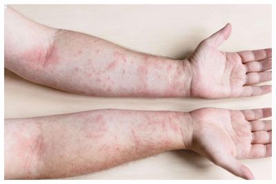 Kulit Tiba-tiba Gatal dan Merah? Bisa Jadi Dermatitis Kontak, Ini Cara Mengatasinya di Rumah