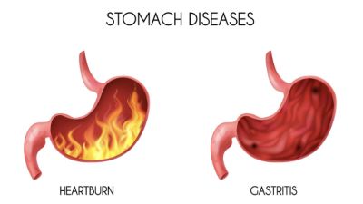 Mengatasi Gastritis Kronis: Mengenal Obat dan Perawatan yang Efektif