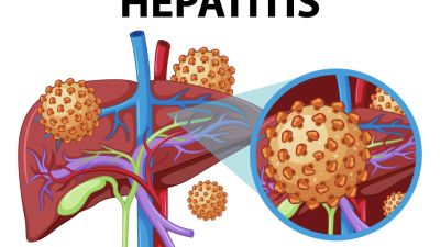 Mengetahui Hepatitis A: Gejala, Pengobatan, dan Cara Pencegahannya