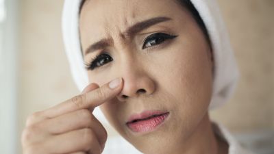 Metode Efektif Menyingkirkan Komedo Tanpa Pencetan