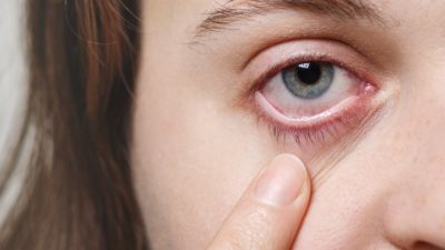 Mengenali Gejala dan Penanganan Konjungtivitis pada Kesehatan Mata